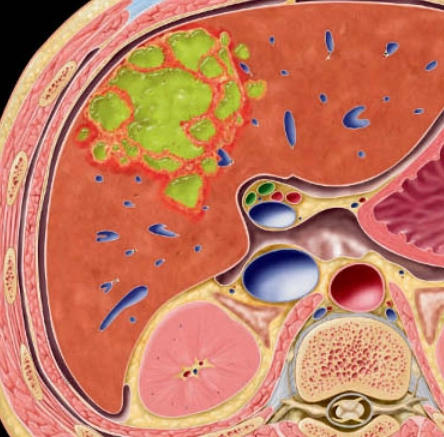 Áp xe gan (Hepatic abscess)