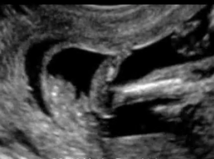 Bàn chân gót lồi- Bàn chân ngựa gỗ (Rocker-Bottom Foot)