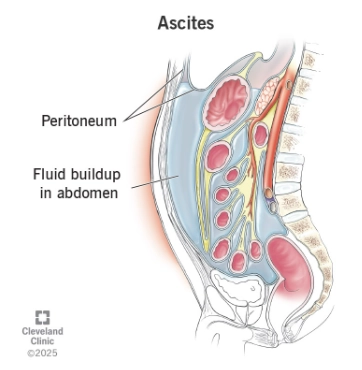 Tràn dịch màng bụng (Ascites)