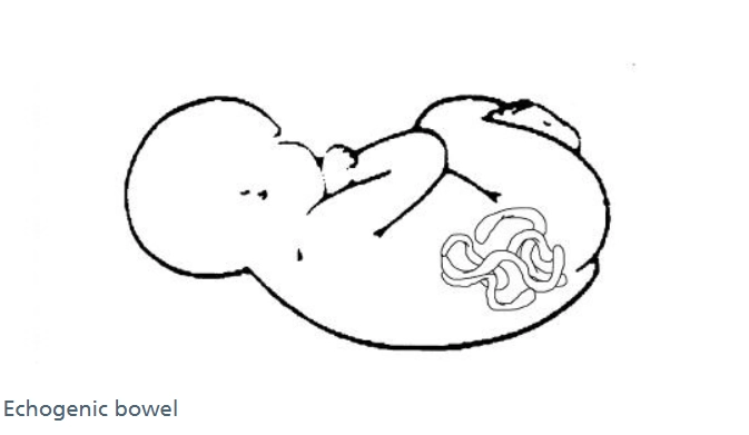 Ruột tăng âm thai quý I (Echogenic bowel)