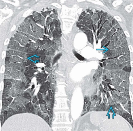 Viêm phổi tăng bạch cầu ái toan cấp tính (Acute Eosinophilic Pneumonia - AEP)