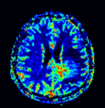 Hiện tượng khối u giả đáp ứng sau điều trị (Pseudoresponse)