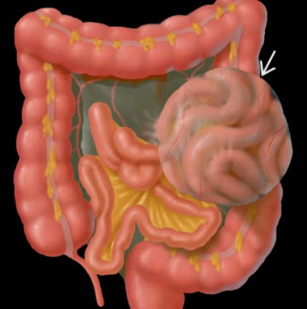 Thoát vị cạnh tá tràng (Paraduodenal Hernia)