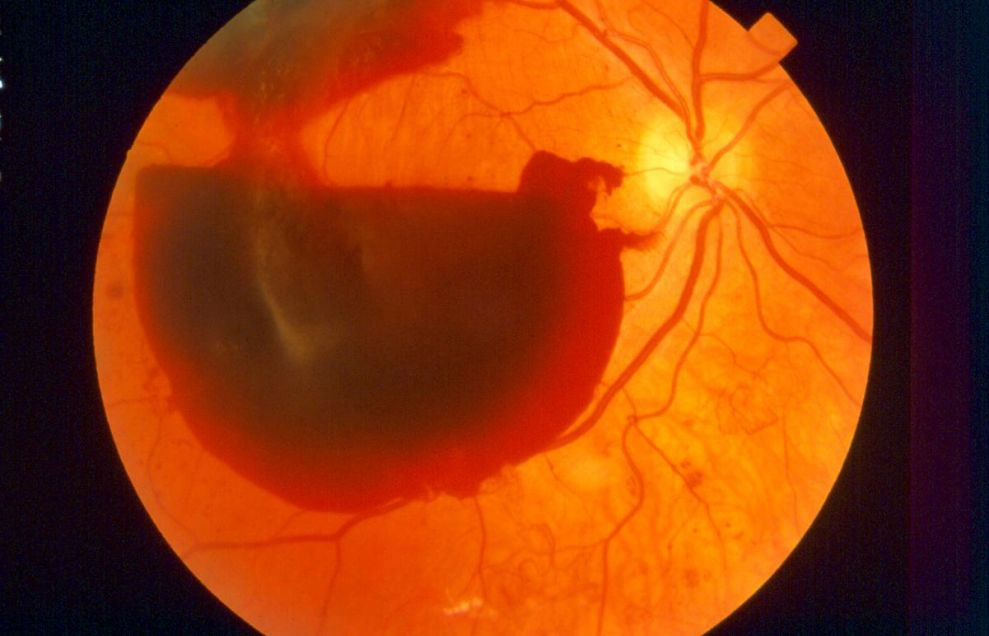 Hội chứng Terson (Terson syndrome)