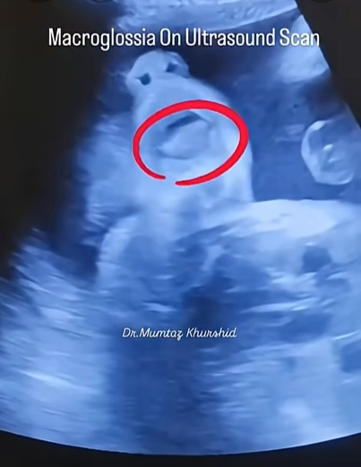 Tật lưỡi to thai nhi (Macroglossia)