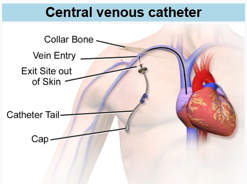 Catheter tĩnh mạch trung tâm (Central venous catheter - CVC)