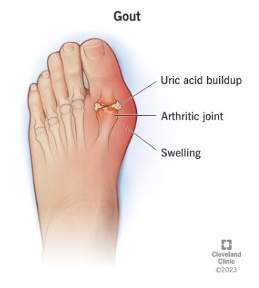 Bệnh Gout