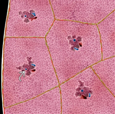 Khí phế thũng trung tâm tiểu thùy (Centrilobular Pulmonary Emphysema)