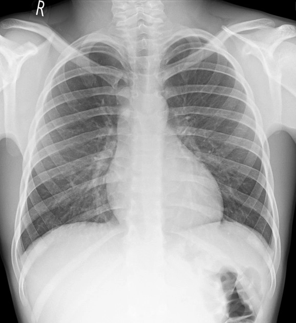 Lồng ngực Nhi (Pediatric Chest)