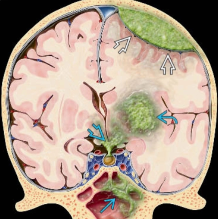 Bệnh bạch cầu biểu hiện ở hệ thần kinh trung ương (Leukemia)