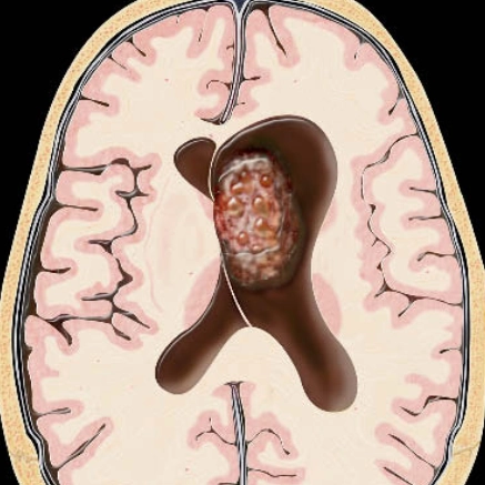 U tế bào thần kinh trung ương (Central Neurocytoma- CN)