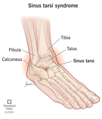 Hội chứng xoang cổ chân (Sinus tarsi syndrome) 