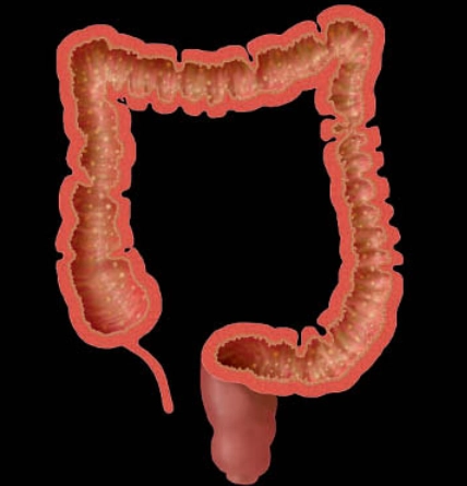 Viêm đại tràng nhiễm trùng (Infectious colitis)