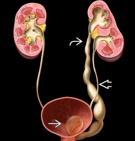 Niệu quản đôi (Ureteral duplication)
