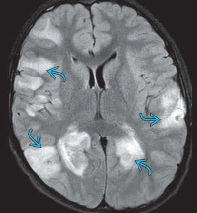 Viêm não tủy rải rác cấp tính- ADEM (Acute Disseminated Encephalomyelitis - ADEM)