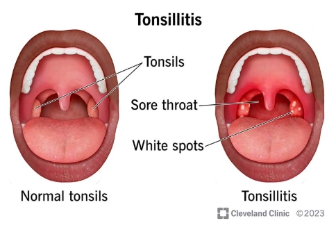 Viêm amidan (Tonsillitis)