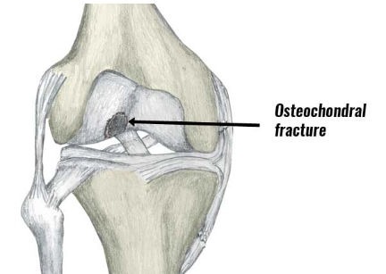 Chấn thương sụn xương khớp gối (Osteochondral Injury, Knee)