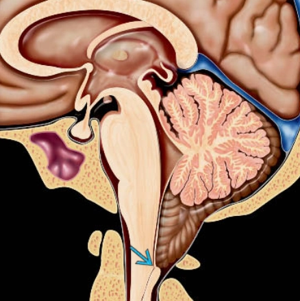 DỊ DẠNG CHIARI TUÝP I (CHIARI I MALFORMATION)