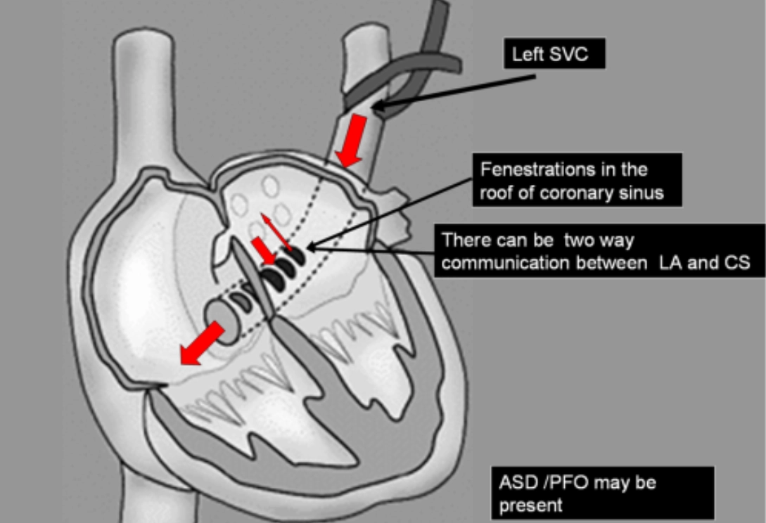 Thông liên nhĩ xoang vành (ASD-cs)
