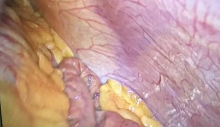 Khí trong thành ruột (Intramural bowel gas)