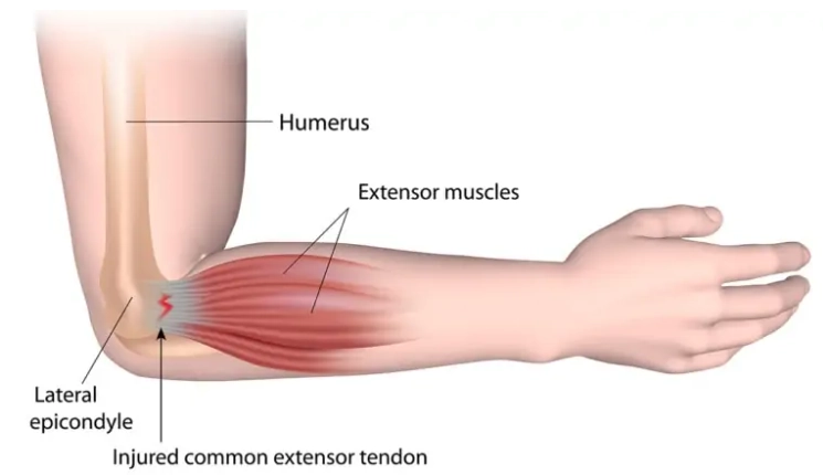 Tổn thương gân duỗi chung ở khuỷu (Common Extensor Tendon Injury)