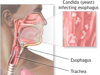 Viêm thực quản do virus (Viral Esophagitis)