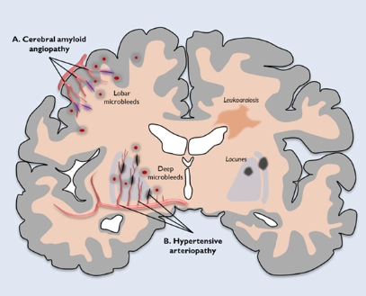 Vi xuất huyết não (Cerebral Microhemorrhage - CMB)
