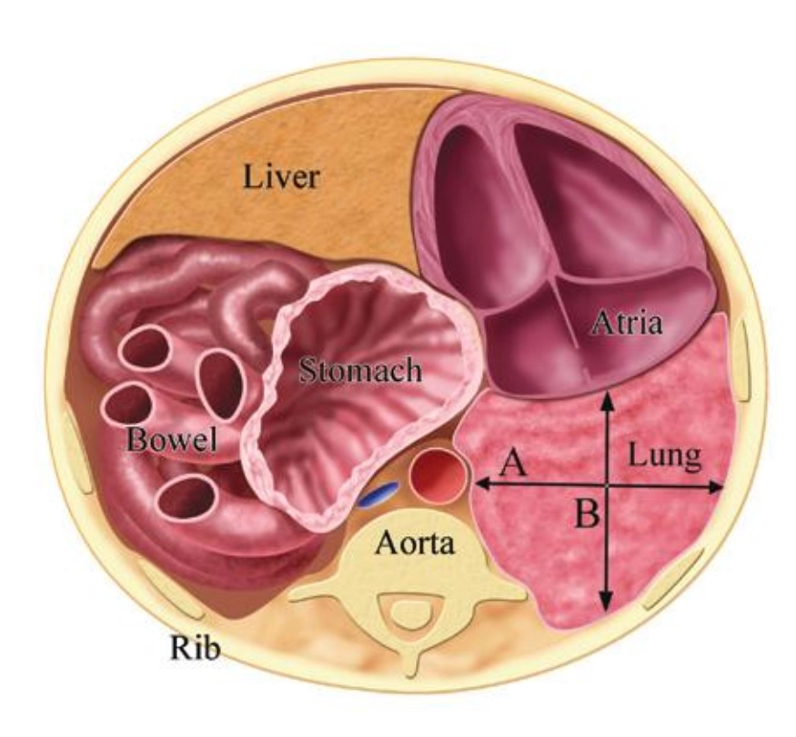 Thoát vị hoành bẩm sinh thai nhi (Congenital Diaphragmatic Hernia)