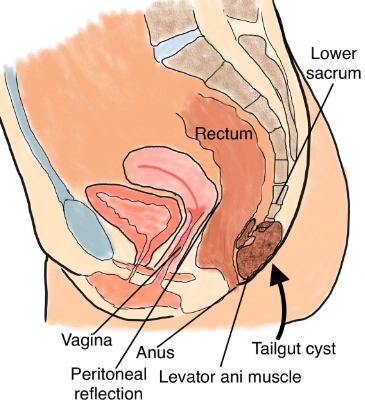 Nang đuôi ruột (Tailgut cyst)