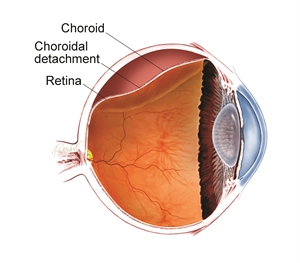 Bong hắc mạc (Choroidal detachment)