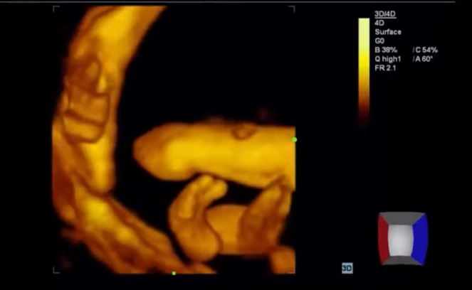 Dị tật cụt chi thai (Amelia ) / Chi hải cẩu (Phocomelia)