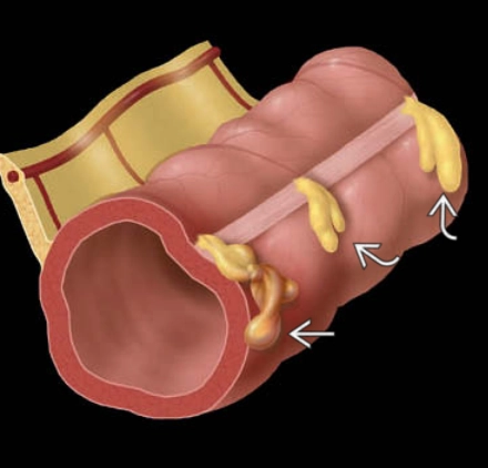 Viêm bờm mỡ đại tràng (Epiploic appendagitis)