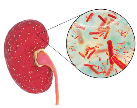 Viêm bể thận cấp (Acute pyelonephritis)
