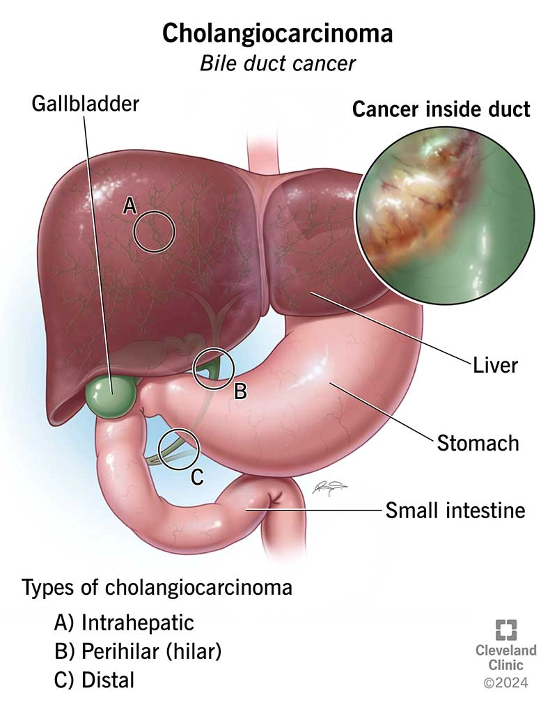 Phân loại giai đoạn ung thư đường mật trong gan (Intrahepatic cholangiocarcinoma (staging))