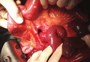 Thoát vị quanh manh tràng (Pericaecal Hernia)