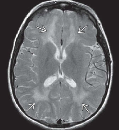 Viêm não xơ cứng bán cấp (Subacute Sclerosing Panencephalitis - SSPE)