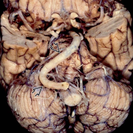 Giãn quanh co động mạch sống- nền động mạch (Vertebrobasilar Dolichoectasia- VBD)