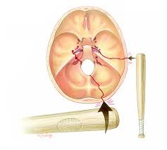 Gãy xương thái dương (Temporal bone fracture)