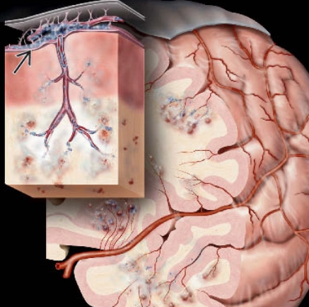 U lympho nội mạch (Intravascular (angiocentric) lymphoma - IVL)
