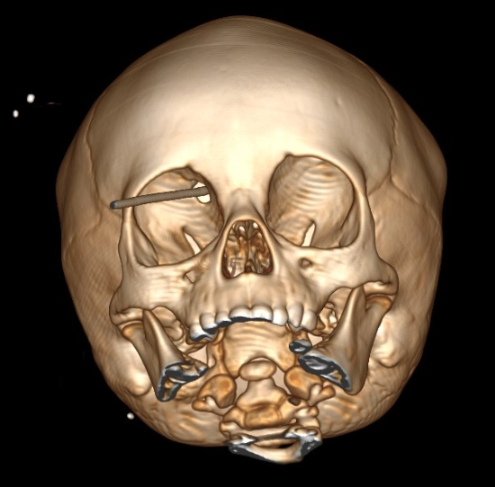 Tổn thương xuyên thấu sọ não vận tốc thấp (Low-velocity penetrating brain injury)
