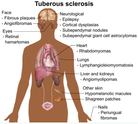 Bệnh xơ cứng củ ở não (Tuberous sclerosis)