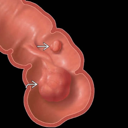 Polyp đại tràng (Colon polyp)