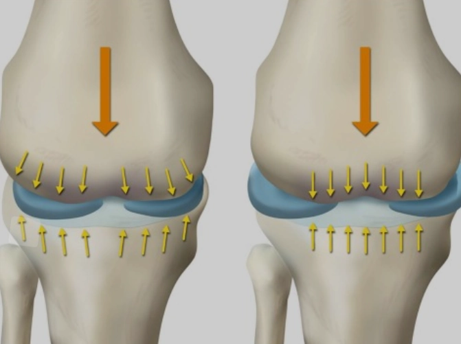  Thoát vị sụn chêm (Meniscal extrusion) 