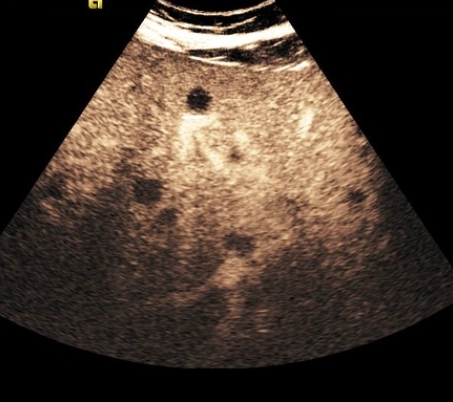 Nhiễm Candida ở gan lách (Hepatosplenic candidiasis)