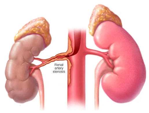 Hẹp động mạch thận (Renal artery stenosis - RAS)