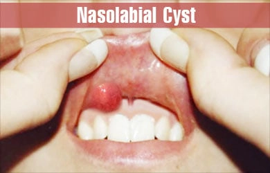 Nang mũi môi (Nasolabial cysts)