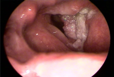 Ung thư biểu mô tế bào vảy của thanh quản (Squamous cell carcinoma of the larynx)