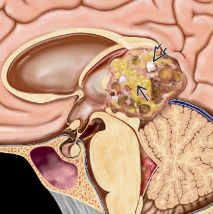 U quái nội sọ (Intracranial Teratomas) 