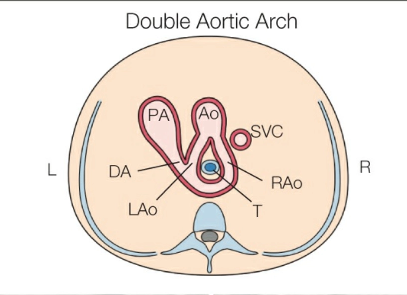 Cung động mạch chủ đôi