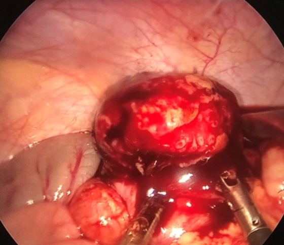 U mỡ van hồi manh tràng (Lipoma of ileocecal valve)
